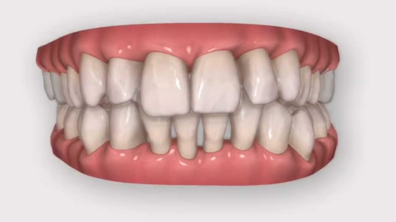 Invisalign Prima e Dopo - Denti Sventagliati - Bologna
