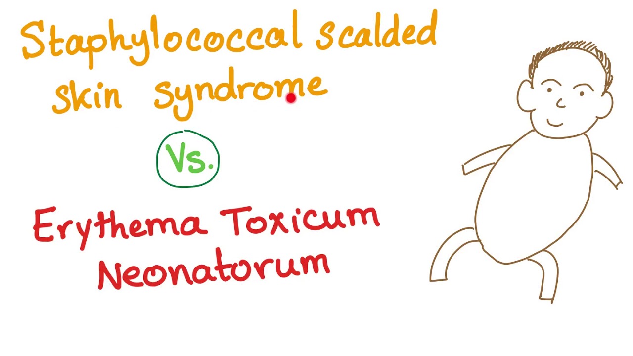 Staphylococcal Scalded Skin Syndrome V.S. Erythema Toxicum Neonatorum