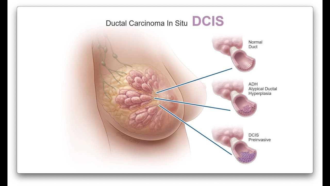 What is DCIS & how is it treated?
