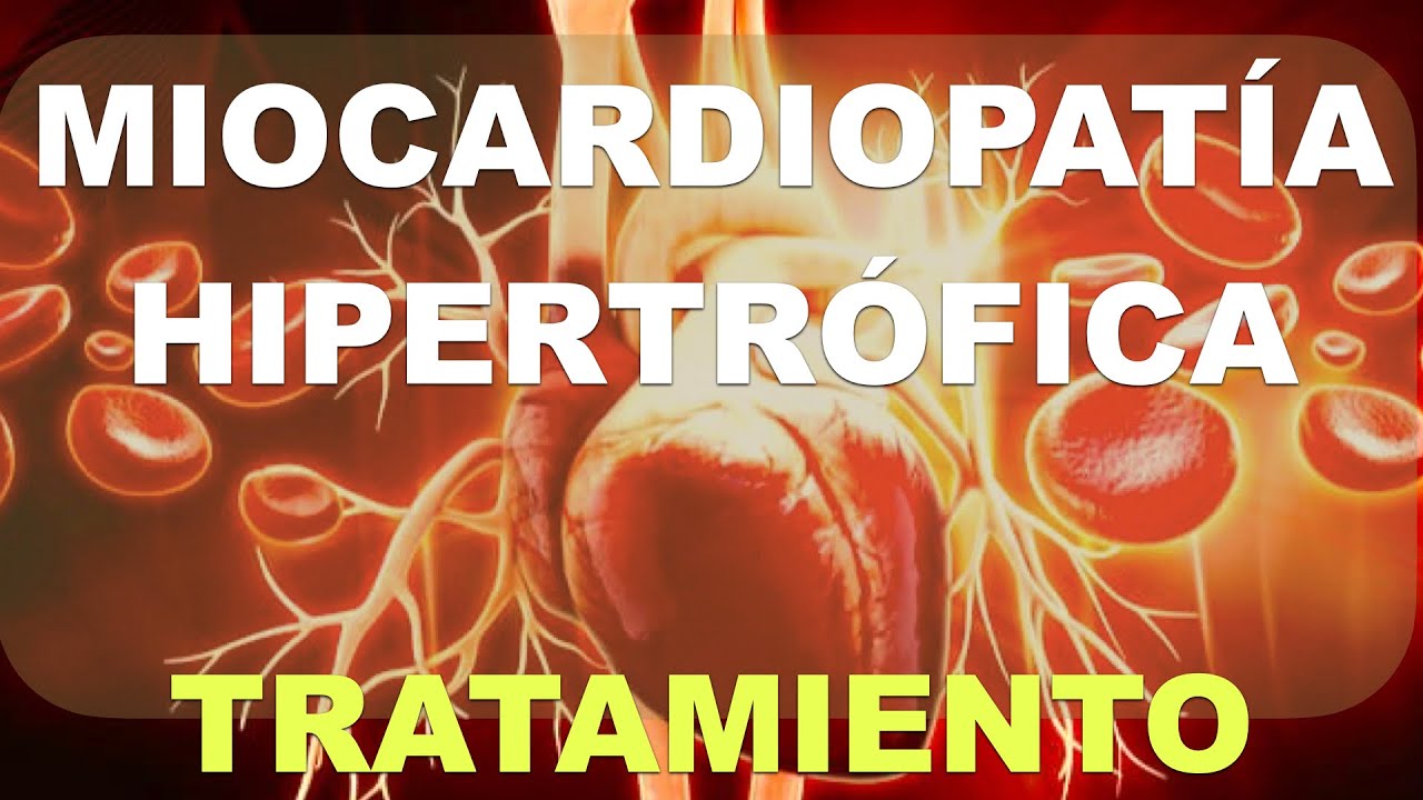 Miocardiopat&iacute;a hipertrofica. Tratamiento