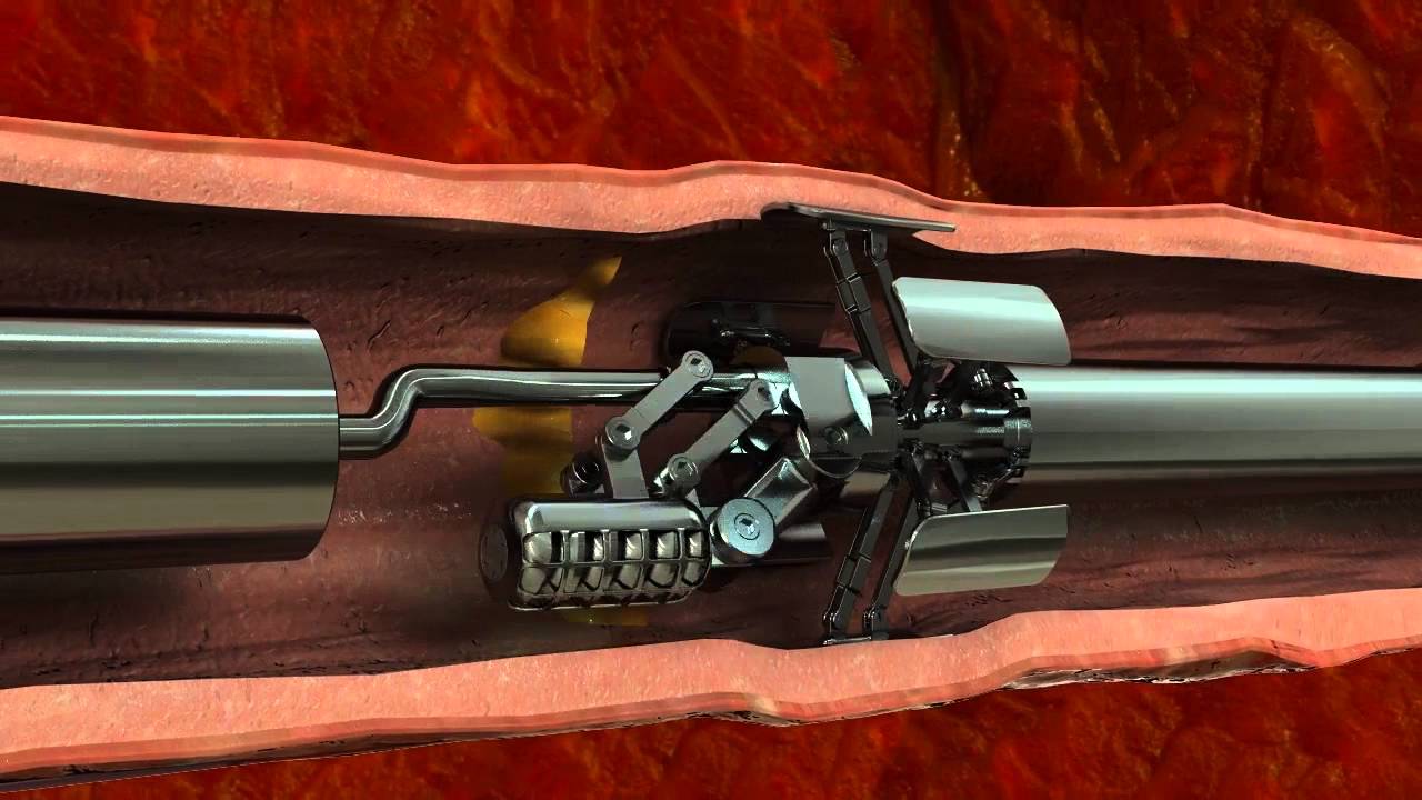 Dahir Insaat   Cholesterol Deposit Removal