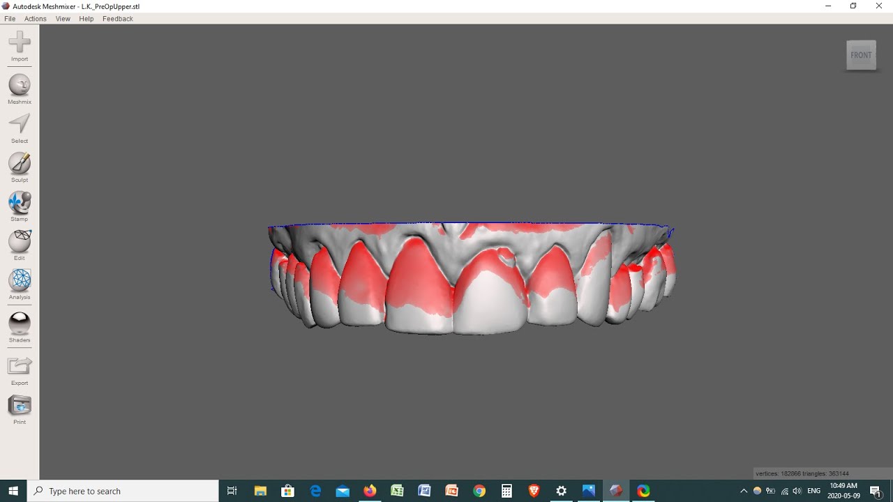 Meshmixer - Undercuts in Dental Model