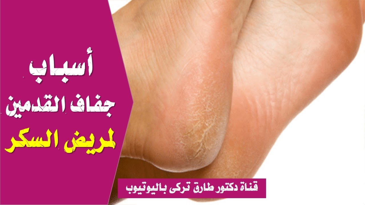 ١٠ اسباب لجفاف وتشقق القدمين لمرضى السكر