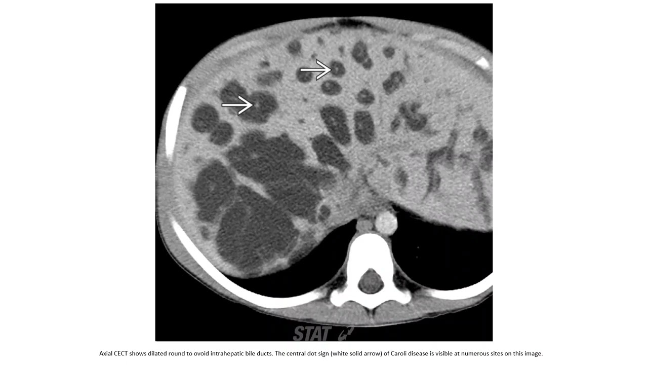 Caroli Disease Imaging