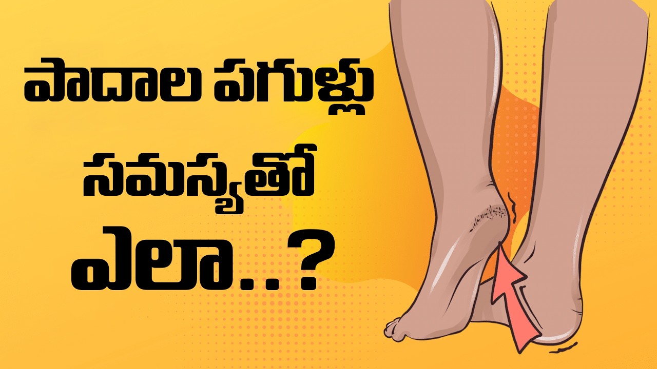 పాదాల పగుళ్లు సమస్యతో ఎలా..? | Heel Cracks Treatment in Telugu | Dr. Pavushetty Sreedhar