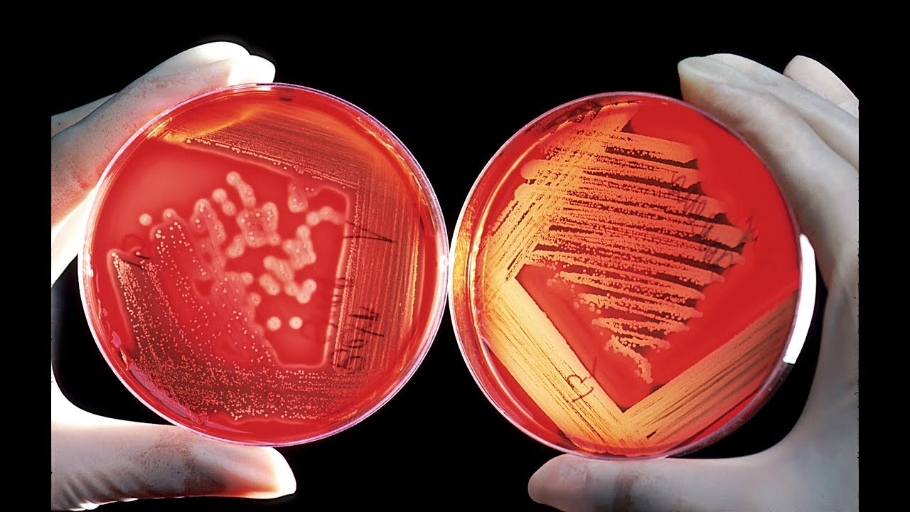 Listeria Monocytogenes: Lawyer Discusses Listeriosis Meningitis Compensation