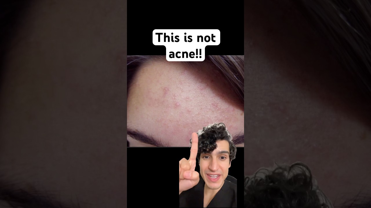 Derm explains what&rsquo;s actually causing your forehead acne #acnetreatment #acnecauses #fungalacne