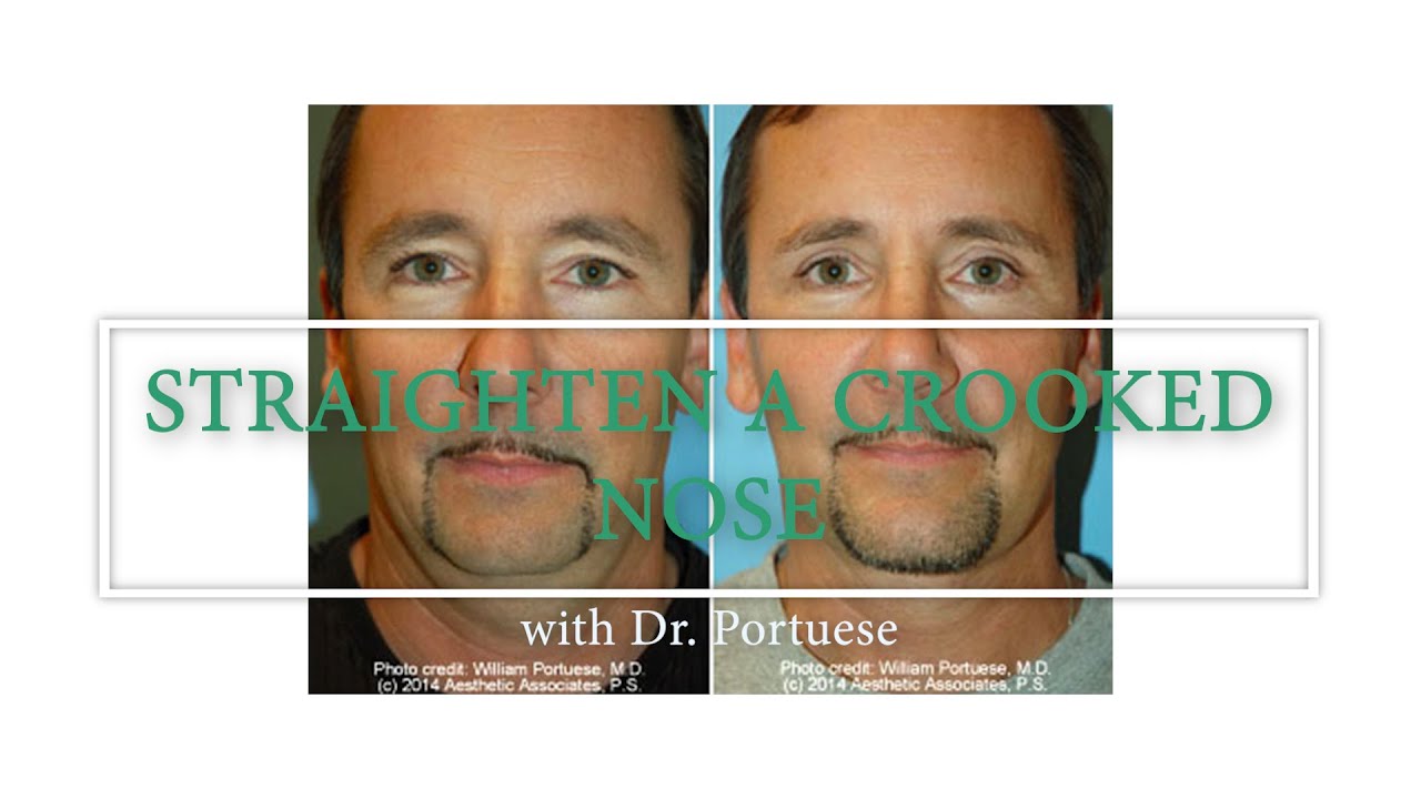 Closed Rhinoplasty Surgery - Straightening a Crooked Nose