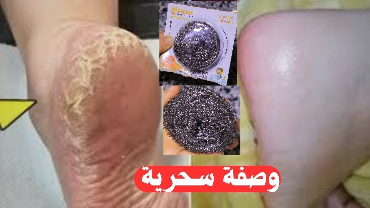 قطعة سلك وقولي وداعآ لتشققات وخشونه القدمين مجربة مني شخصيآ تقشير . تبييض .ترطيب . بياض كاتلج