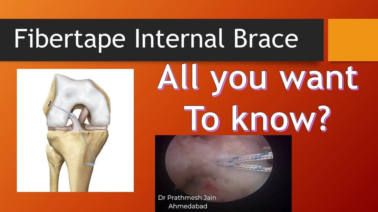 Detail Information regarding Internal Brace with FIBERTAPE