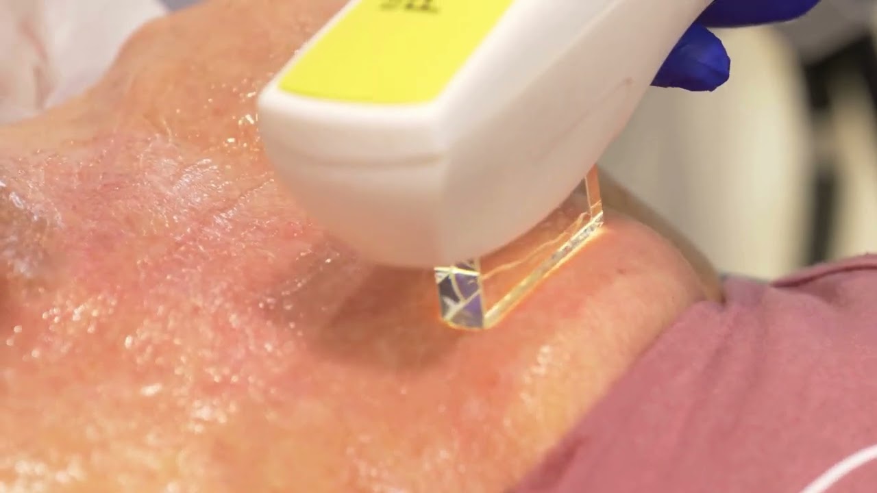 Dr. Didac Barco - Fotorrejuvenecimiento de escote con luz pulsada