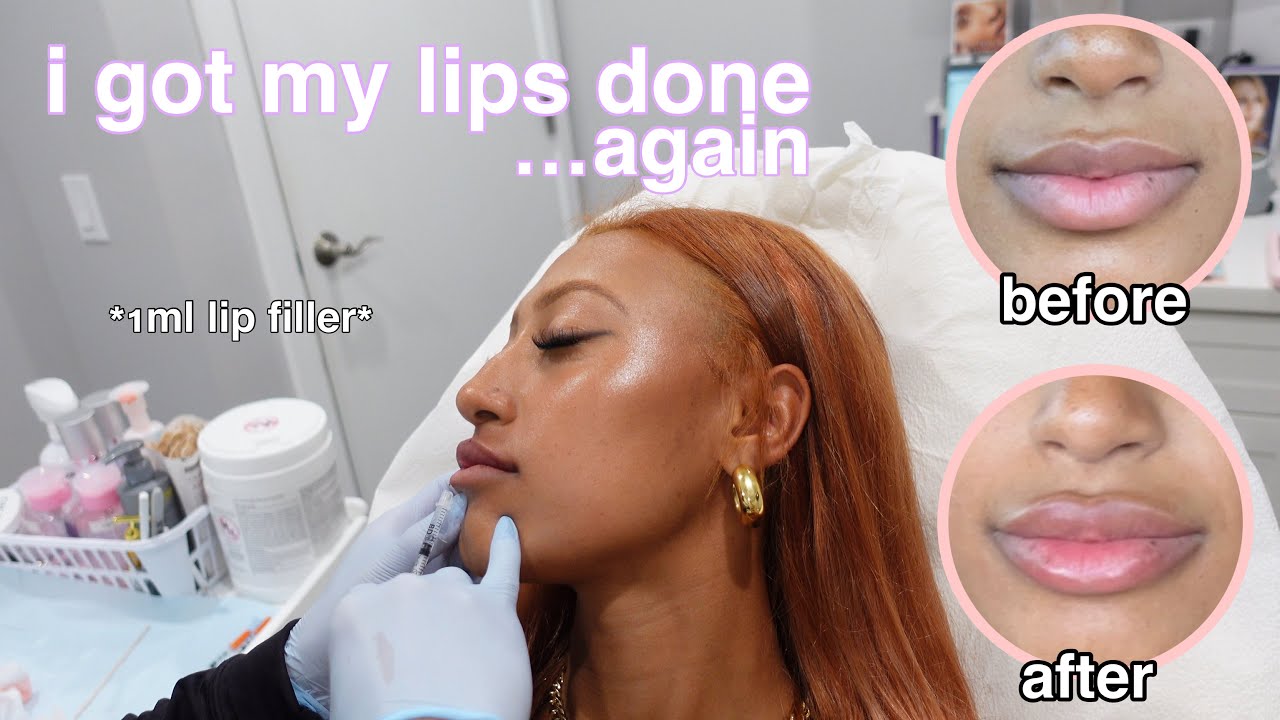 lip filler vlog *russian lip technique with restylane kysse