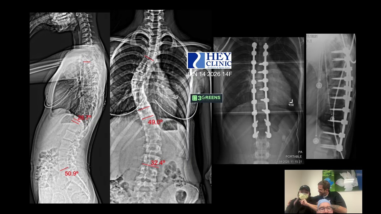 How good of a correction can you get with AIS surgery?