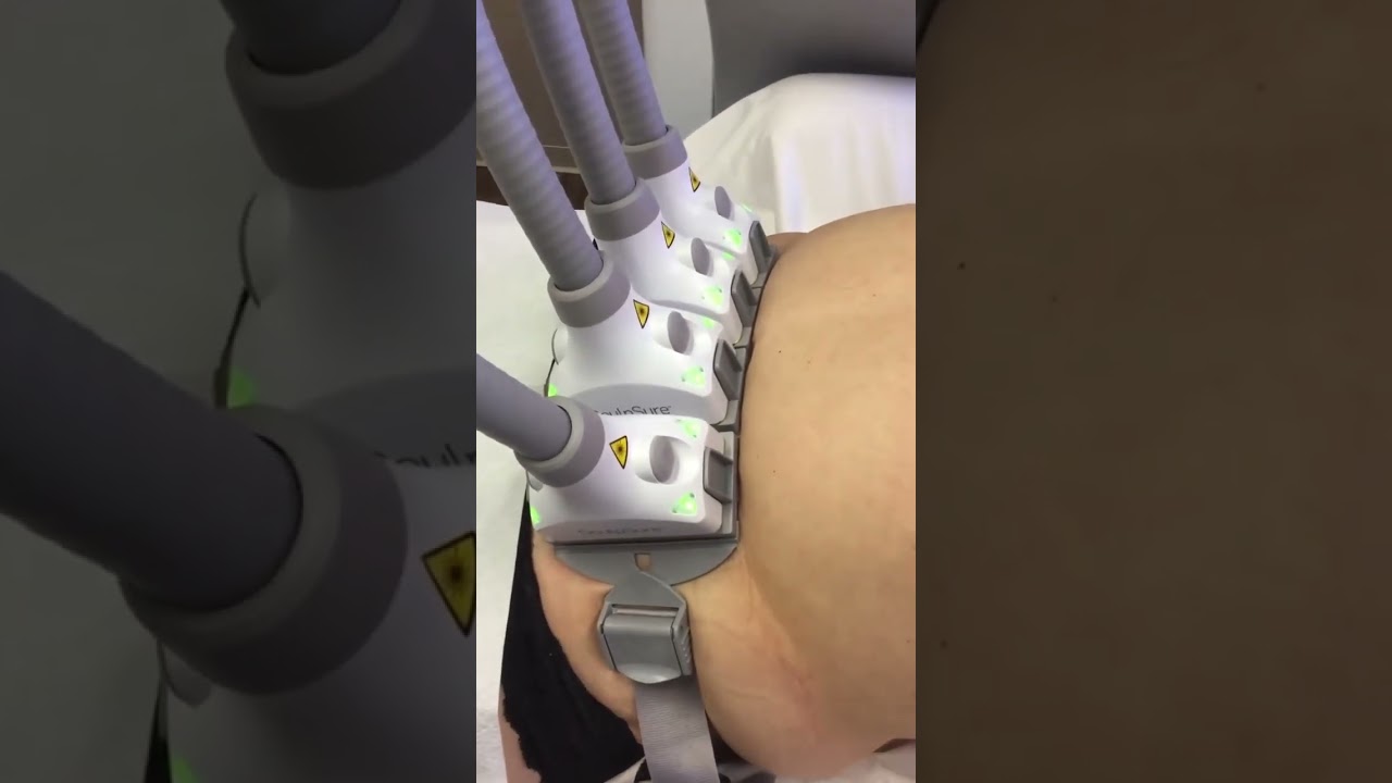 Уменьшение жировых отложений без операции? Это возможно со SculpSure! #sculpsure #fatloss #viral