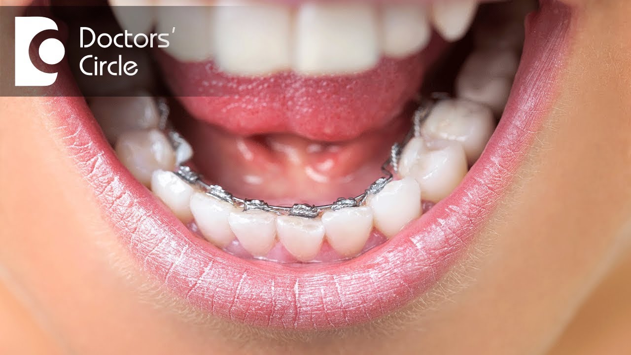What are Lingual Braces & when to go for it? - Dr. Nandini Nelivigi