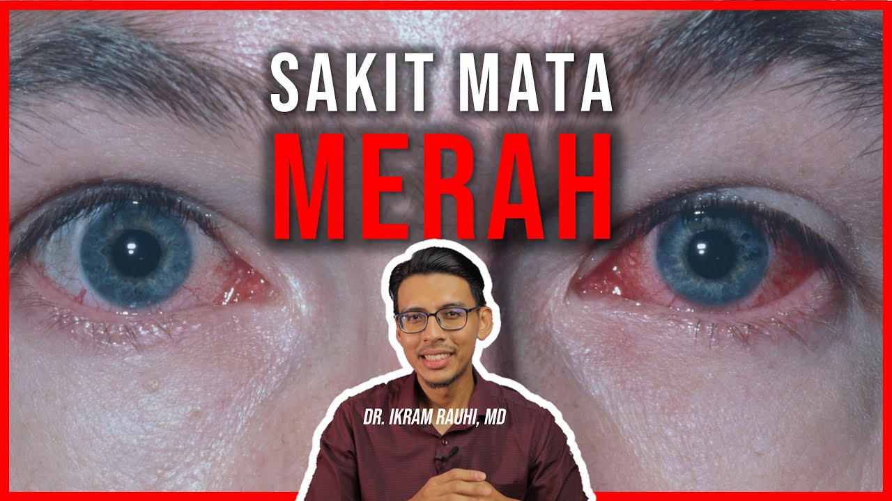 Punca dan Rawatan Sakit Mata Merah (Acute Conjunctivitis). Tips dan Cara Pakai Ubat Titis Mata.