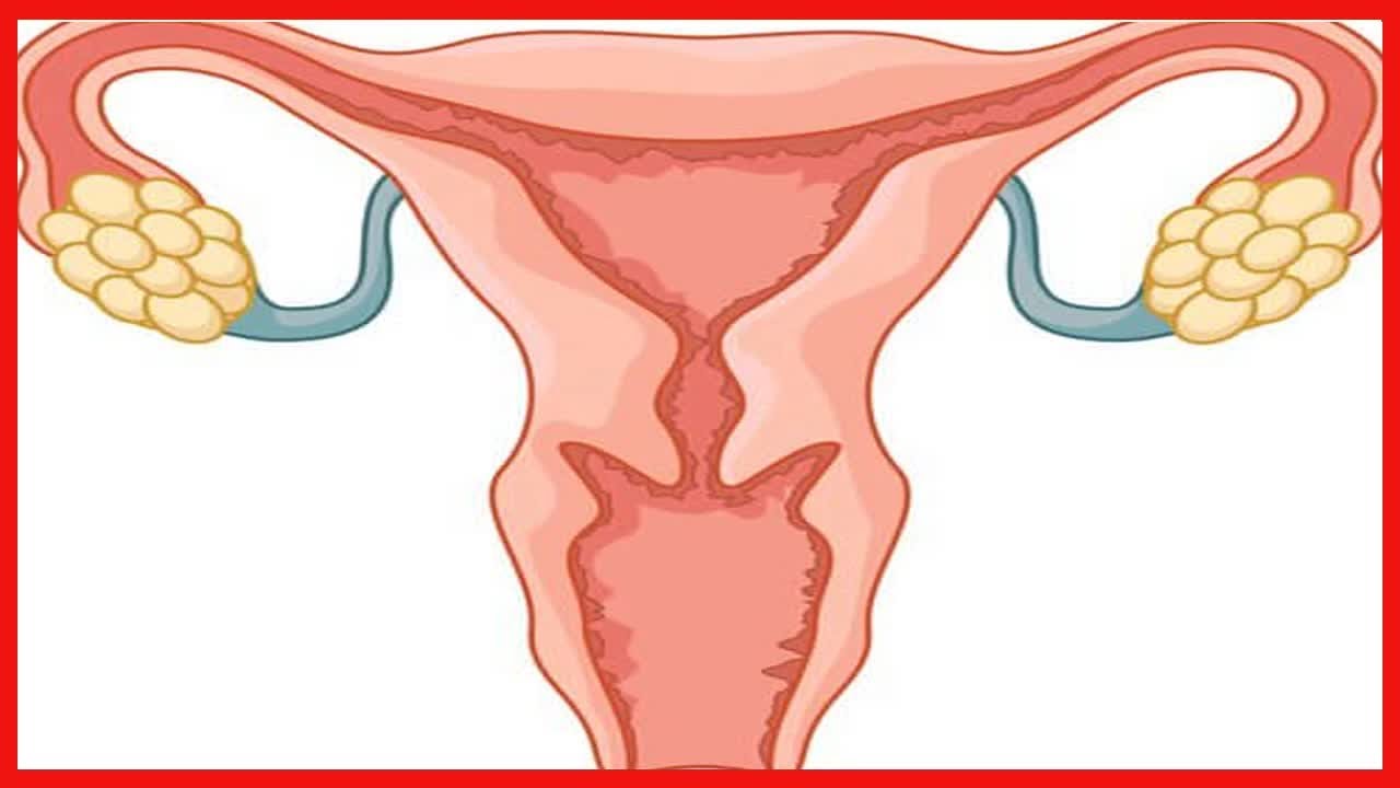6 signes qui permettent de d&eacute;tecter le syndrome des ovaires polykystiques