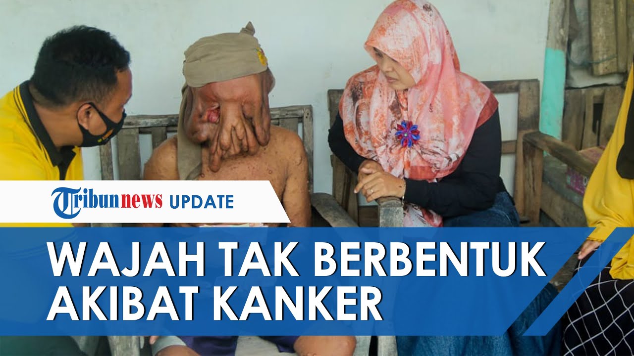 Wajah Tak Berbentuk Akibat Alami Kanker hingga Tak Bisa Melihat, Pria Nganjuk Ini Hidup Sebatangkara