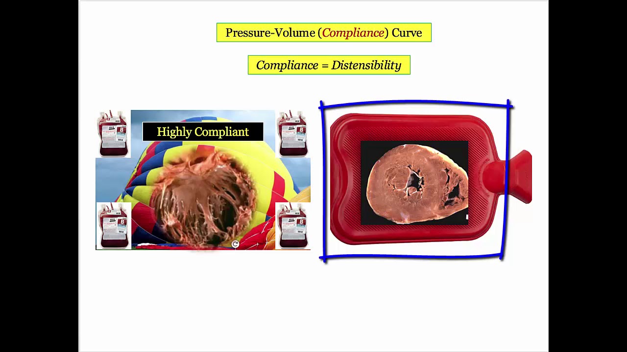 12DaysinMarch, Heart Failure (3): Dilated Cardiomyopathy for the USMLE Step One Exam
