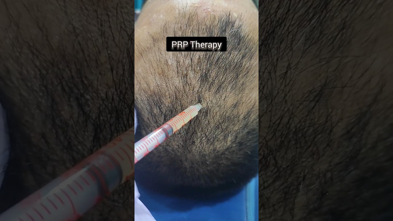 PRP v/s GFC Therapy for Pattern Hair Loss AMAZING Results #prptherapy #gfctherapy #hairlosstreatment