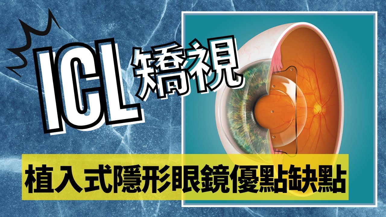 [ICL矯視] icl植入式隱形眼鏡 手術 優點 缺點 後遺症 副作用 lasik smile 比較 icl vs iol 白內障手術 近視1000度雷射? optician 廣東話
