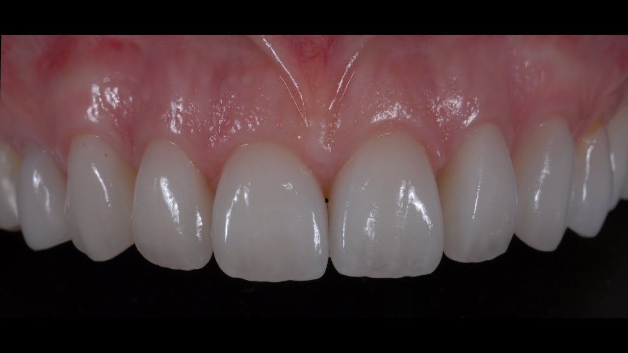 Porcelain Veneer Bonding Under Rubber Dam