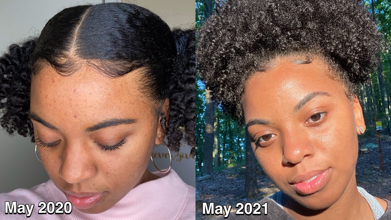 Mistakes I made using Differin Gel | How I cleared my quarantine acne