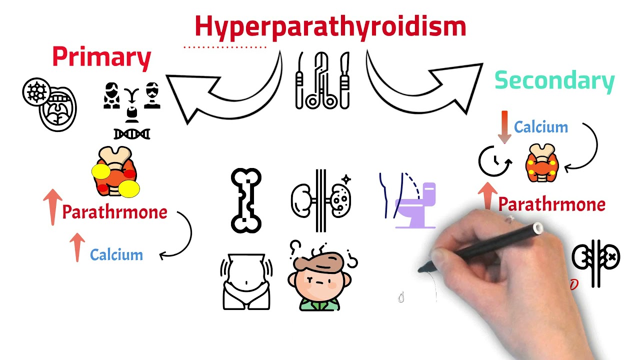 ماذا تعرف عن الغدة الجاردرقية (Parathyroid Gland) | وعلاقتها بالكالسيوم | وأعراض النقص والزيادة؟