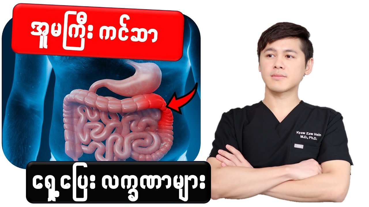 -- အူမကြီးကင်ဆာရဲ့ ရှေ့ပြေးလက္ခဏာ (၄)မျိုး --