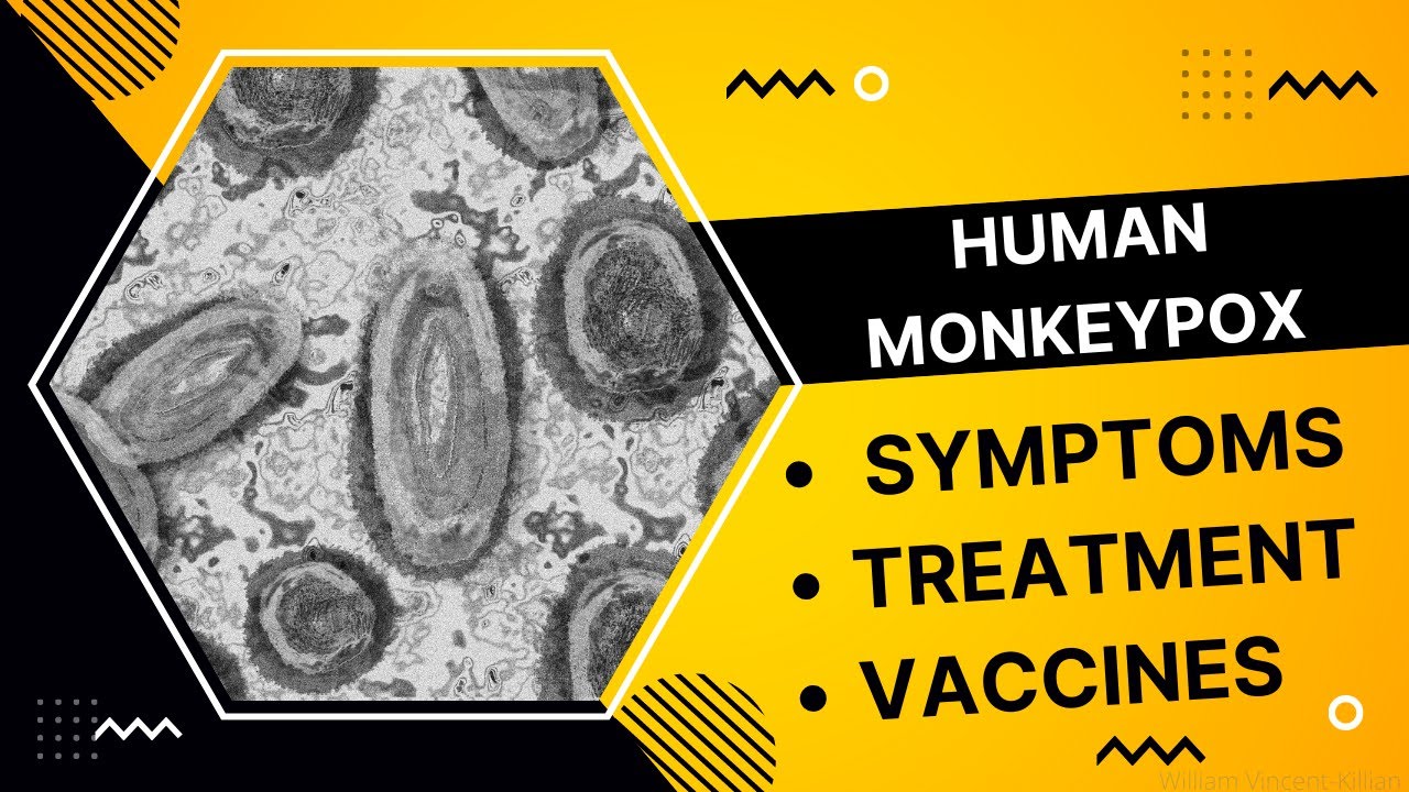 Monkeypox Symptoms, Treatment, Vaccines, and how it Spreads