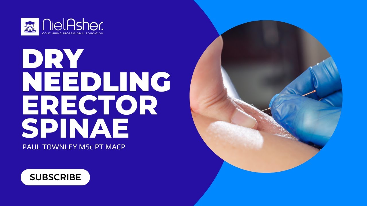 Dry Needling for Trigger Points - Erector Spinae