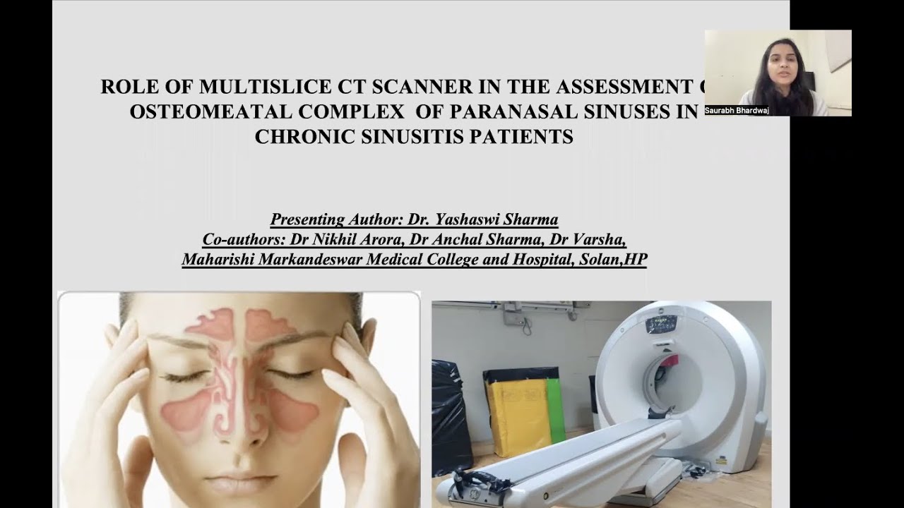 Yashaswi Sharma -CT IN THE ASSESSING OSTEOMEATAL COMPLEX OF PARANASAL SINUSES IN CHRONIC SINUSITIS