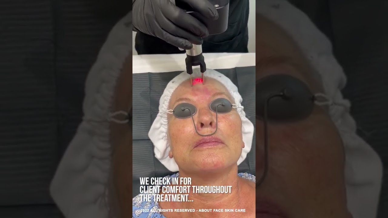 CoolPeel Treatment (CO2) Overview