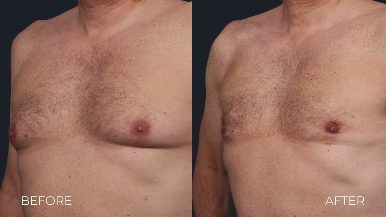 Male Breast Reduction on Older Men: Gynecomastia Surgery
