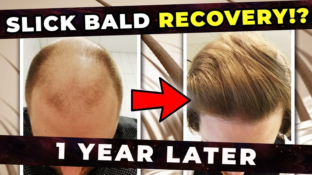 Do Hair Follicles Permanently Die After You Go Bald? Can They Be Recovered?