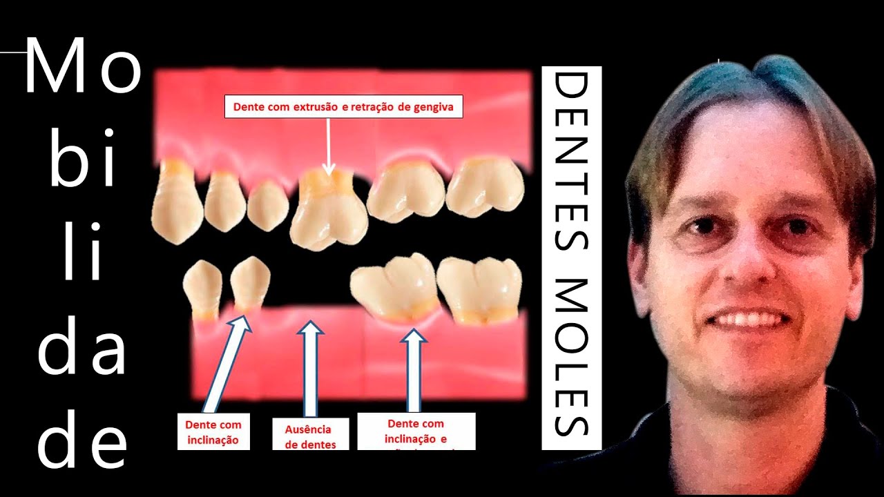 Periodontites, Gengivites e Dentes Moles -  Técnica Ninja para Evitar e Tratar em Casa