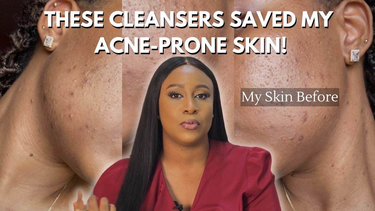 5 Cleansers I Swear By For Acne-Prone Skin (and Won’t Ruin Your Skin Barrier)