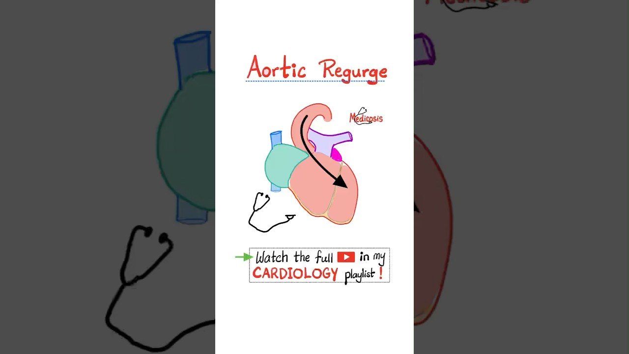 Aortic Regurgitation (AR) - Valvular Heart Disease (VHD)&hellip;#biology #science #cardiology #anatomy