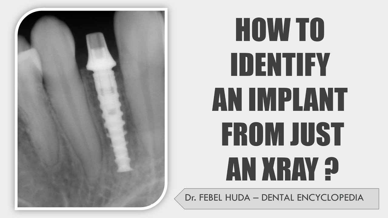 HOW TO IDENTIFY AN IMPLANT  WITH JUST AN X-RAY ?