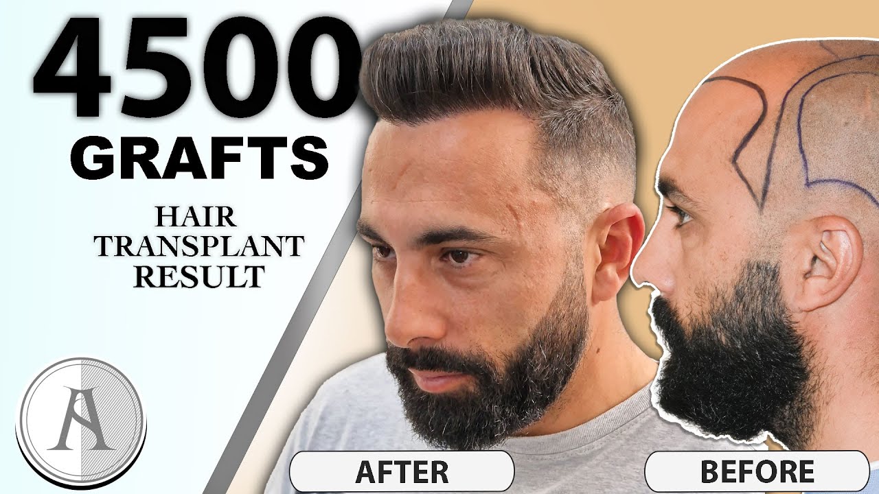 Amazing Hair Transplant Result in Aisha Hair | Resultado Asombroso del Injerto Capilar en Aisha Hair