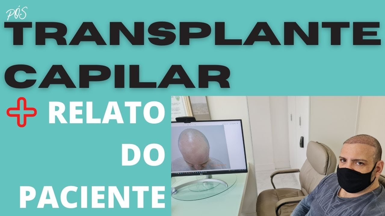 Aparência 12 dias Dr. Paulo Lu Sorocaba #transplante #capilar #fue e depoimento sobre procedimento