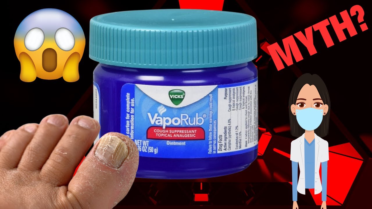 Викс Вапораб от грибка ногтей на ногах: миф или магия?