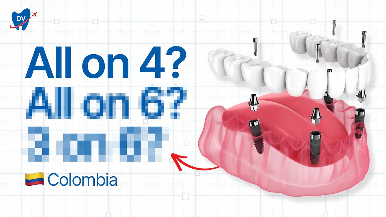 Full Mouth Dental Implants in Bogota (Here’s How Much You Can Save in Colombia)