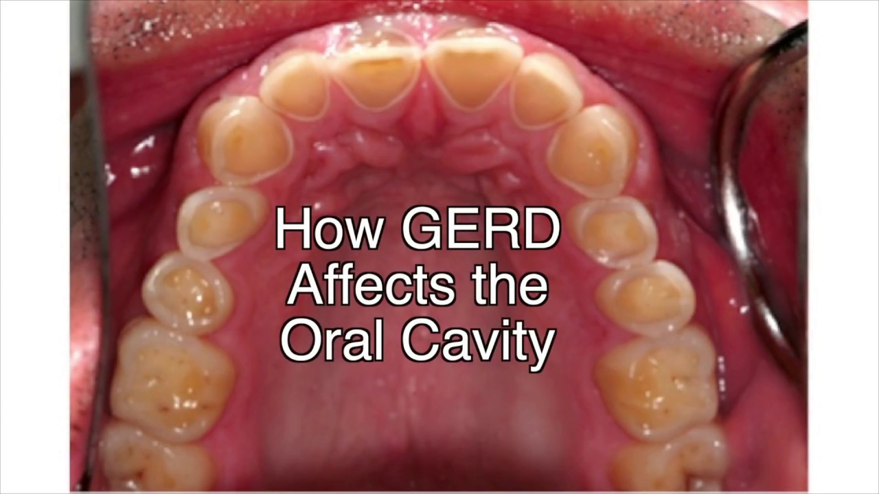 Parkland Dental Hygiene - How GERD Affects the Oral Cavity