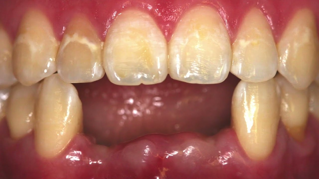 PREVENT BONE LOSS before it happens