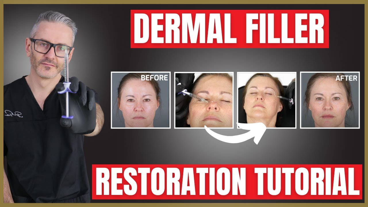Dermal Filler Demonstration & Tutorial | Liquid Rhinoplasty | Nasolabial Folds