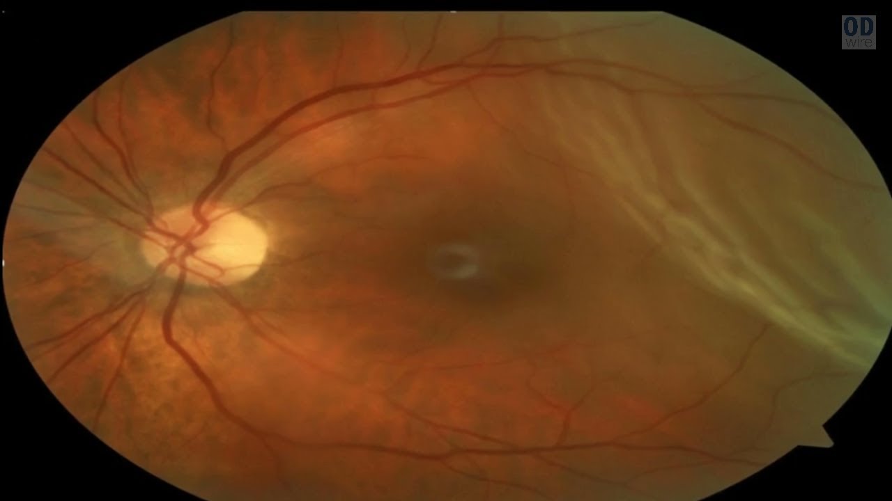 Retinal Detachment or Not?