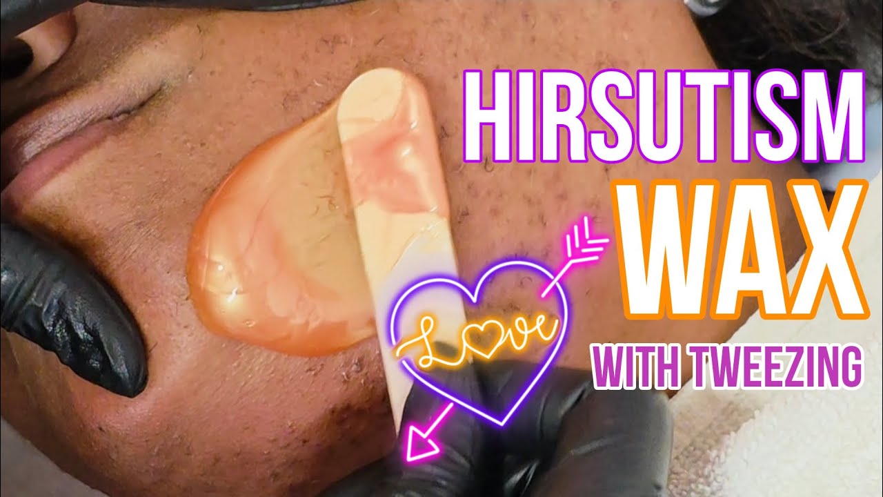 Hirsutism Wax with Tweezing! #Hirsutism #Waxing 