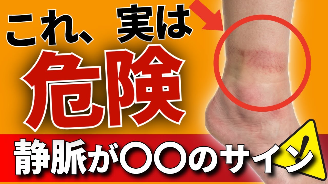 【靴下の跡がくっきり残っていませんか？】実はそれ、血管が壊れる前兆です