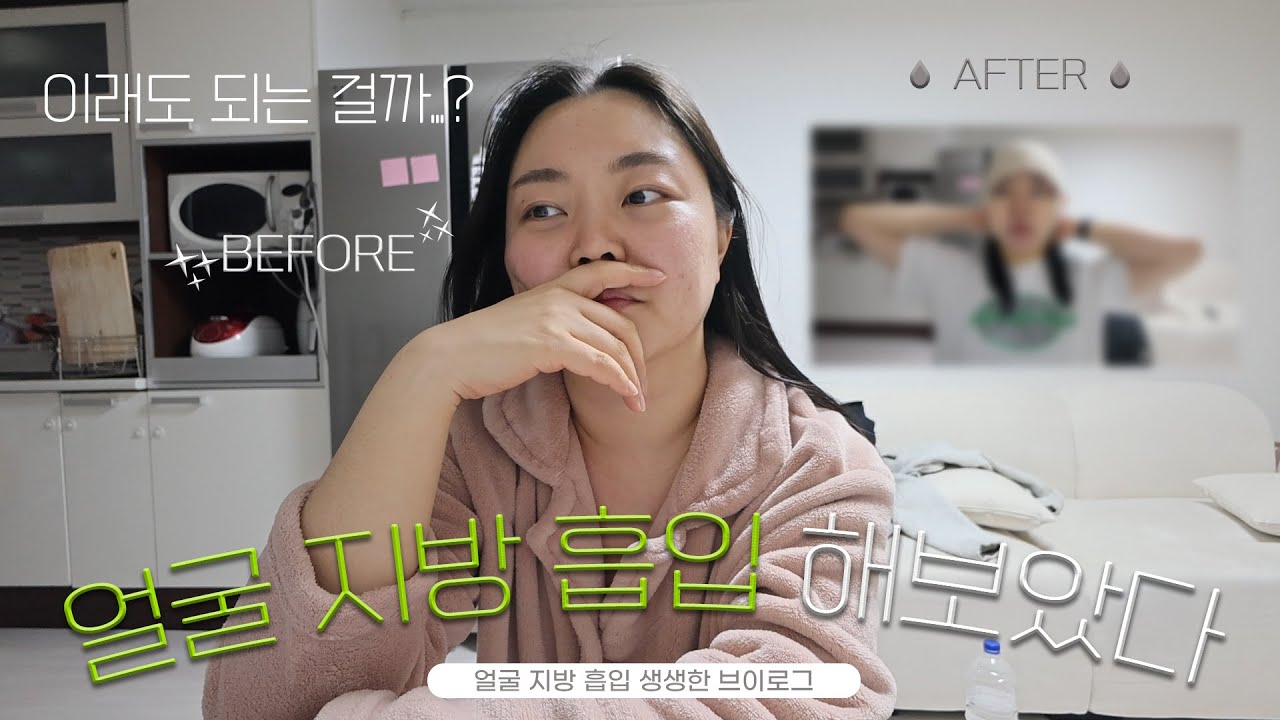 [N잡러 브이로그] 비주얼 충격 주의 얼굴 지방 흡입 리얼 회복(?) 브이로그